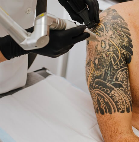 Laser tattoo removal specialist at White Diamond Laser Gold Coast
