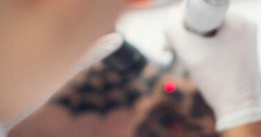Tattoo Removal Results and Timeline Explained - tattoo removal article