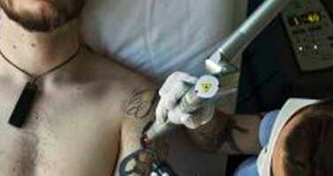 6 Myths About Laser Tattoo Removal Put to Rest - tattoo removal article