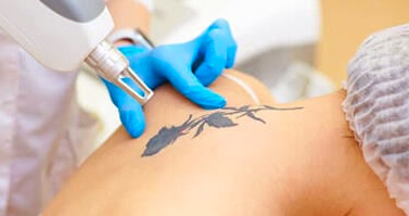 Laser Tattoo Removal Benefits - tattoo removal article