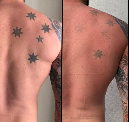 Before and after laser tattoo removal - 2 sessions