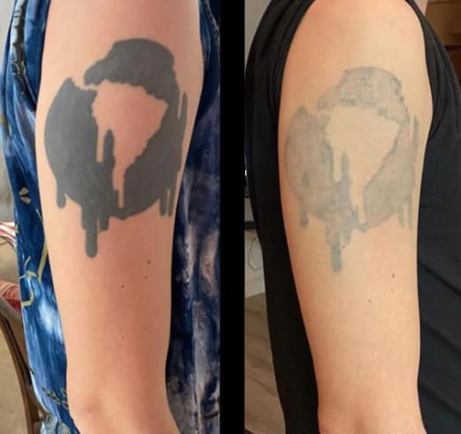 Before and after laser tattoo removal - 4 sessions