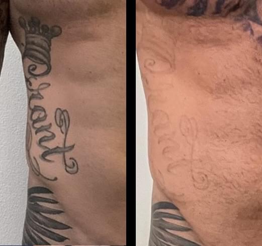 Before and after laser tattoo removal - 4 sessions