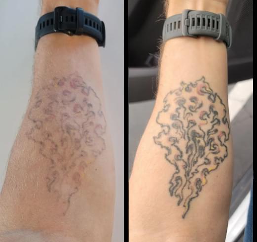 Before and after laser tattoo removal - 2 sessions