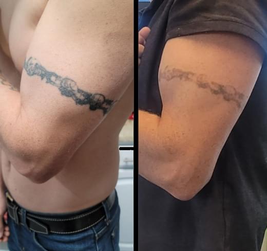 Before and after laser tattoo removal - 3 sessions