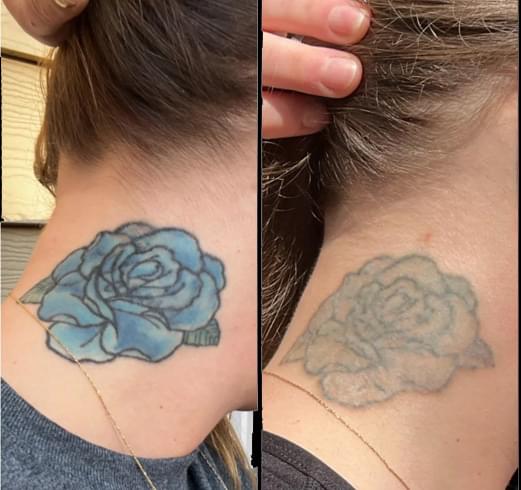 Before and after laser tattoo removal - 4 sessions