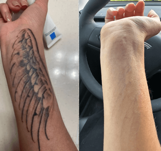 Before and after laser tattoo removal - 6 sessions