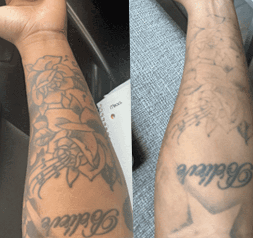 Before and after laser tattoo removal - 4 sessions