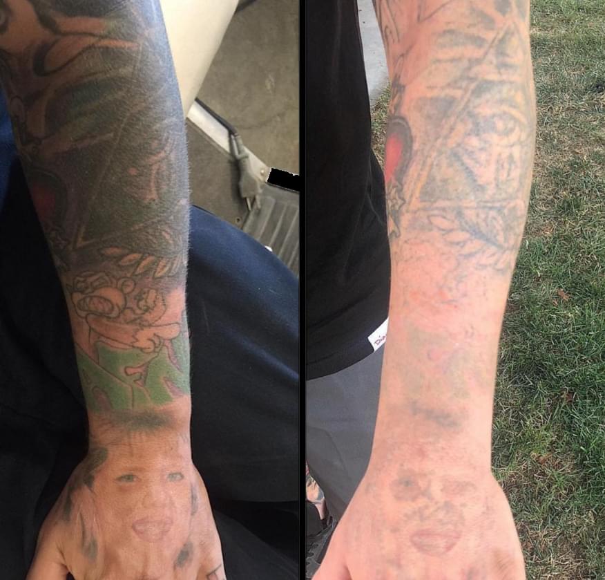 Before and after laser tattoo removal - 6 sessions