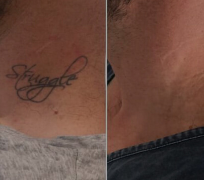 Client success story - neck script tattoo before and after laser removal