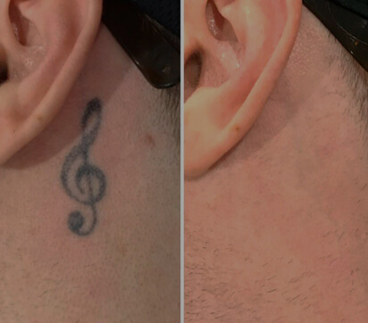 Client success story - tattoo before and after laser removal