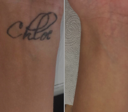 Client success story - tattoo before and after laser removal