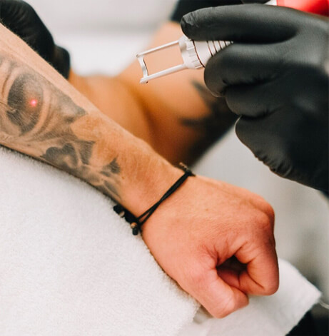 Laser tattoo fading for cover-ups